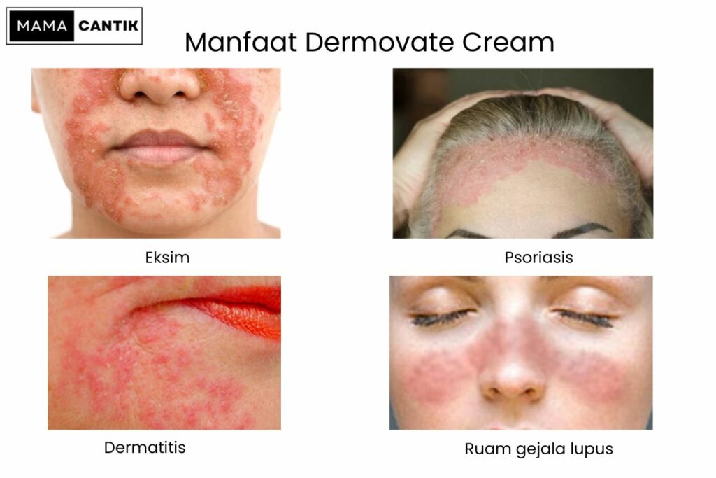 Apakah dermovate cream bisa menghilangkan flek hitam di wajah