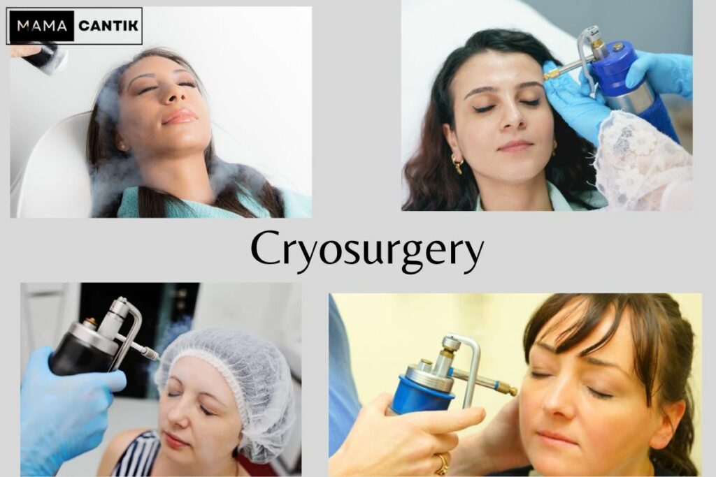Cryosurgery untuk atasi flek hitam