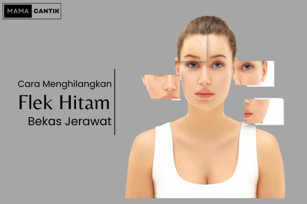 Flek hitam bekas jerawat di wajah