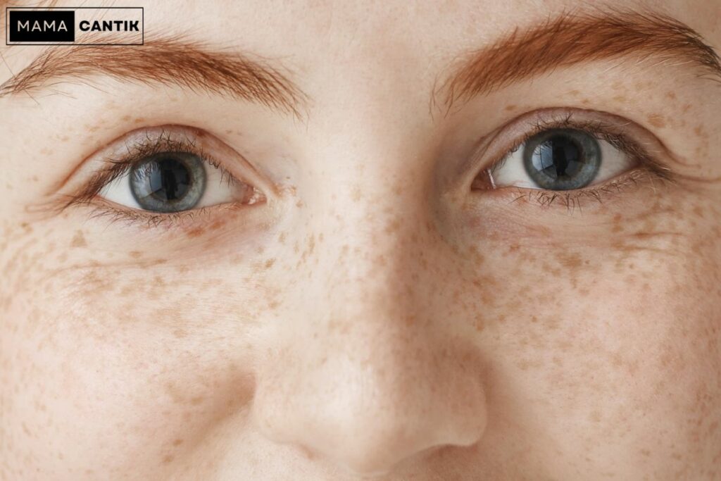 Jenis flek hitam freckles