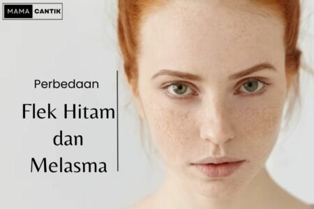 Perbedaan melasma dan flek hitam