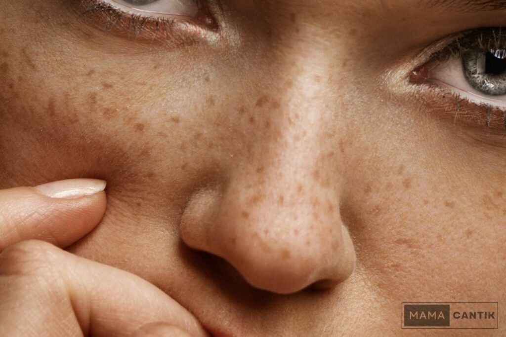 Apa penyebab flek hitam dan freckles