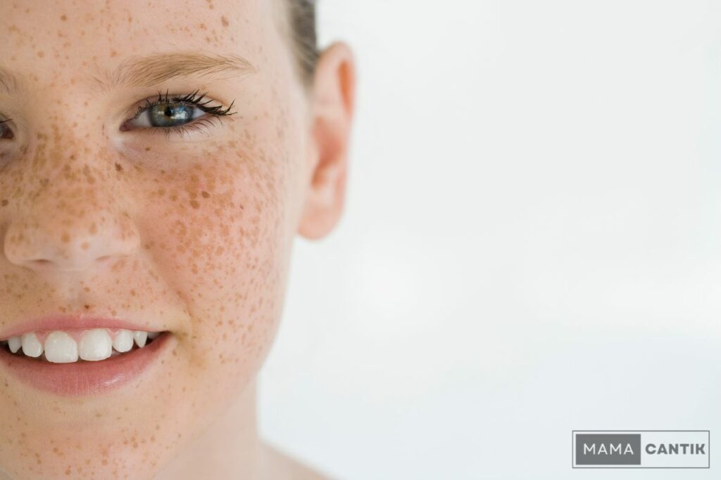 Cara menghilangkan freckles dan flek hitam
