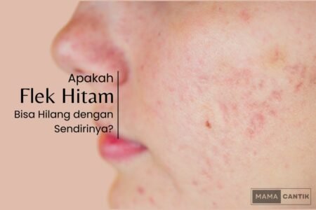 Apakah flek hitam bisa hilang dengan sendirinya