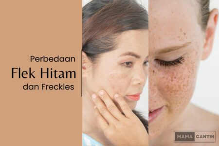 Perbedaan flek hitam dan freckles