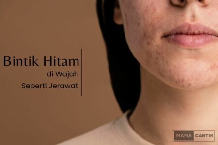 Bintik hitam di wajah seperti jerawat