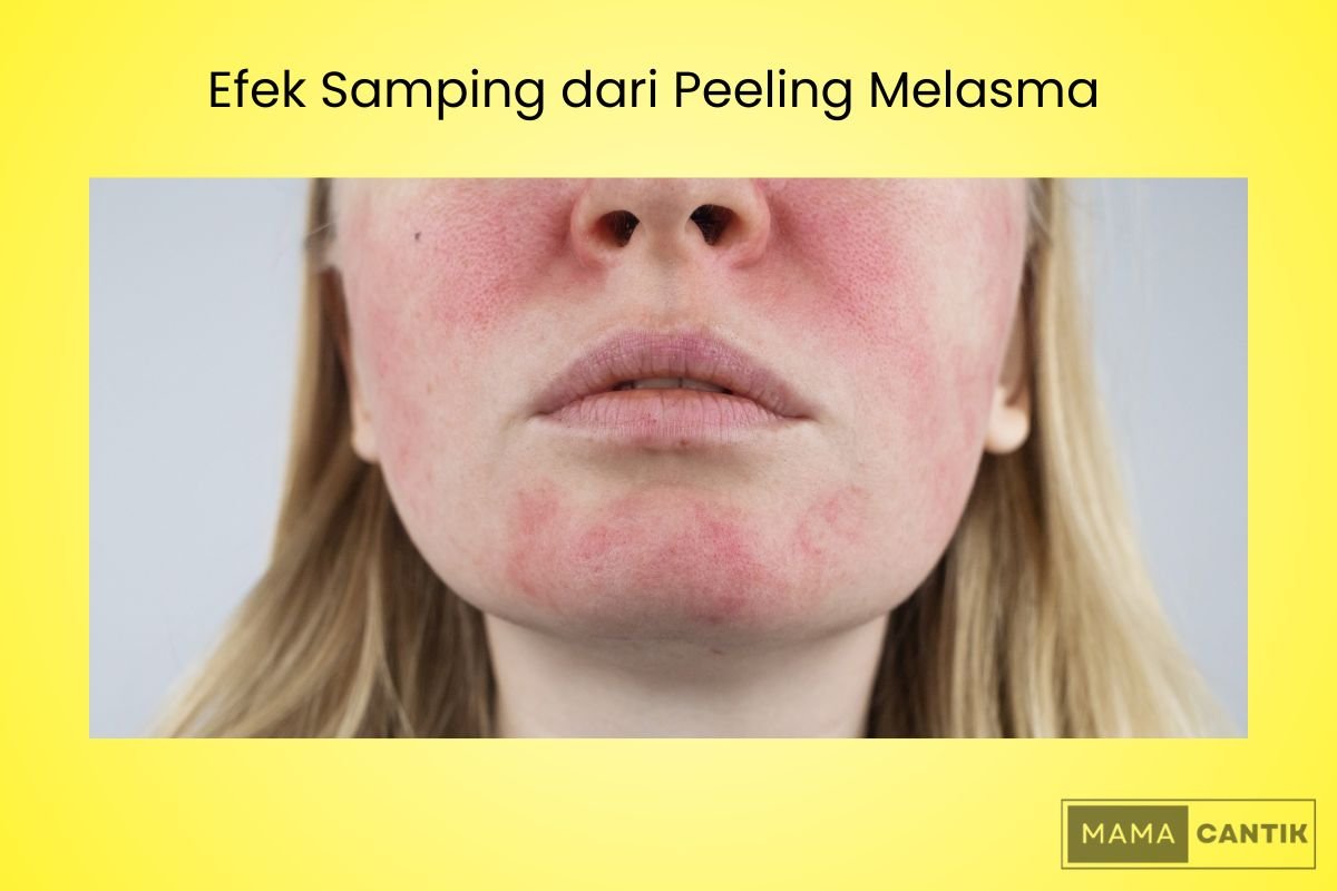 Peeling Melasma: Apa Itu, Manfaat, Efek Samping