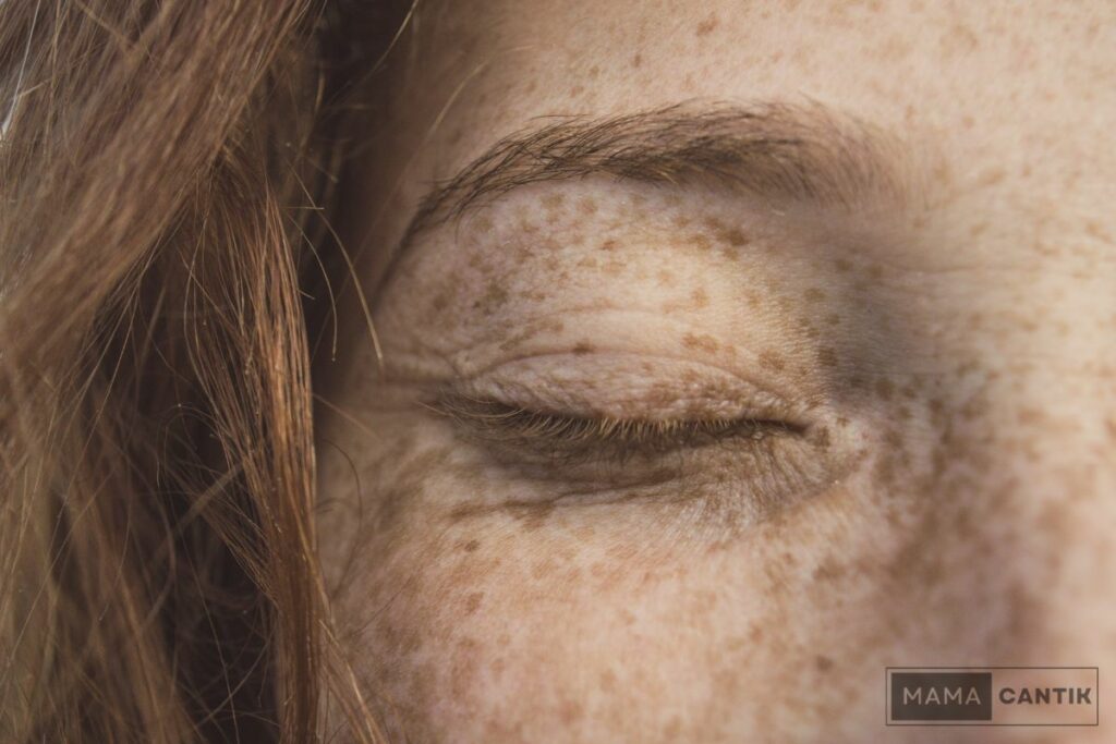 Faktor resiko terkena freckles