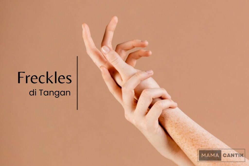Freckles di tangan