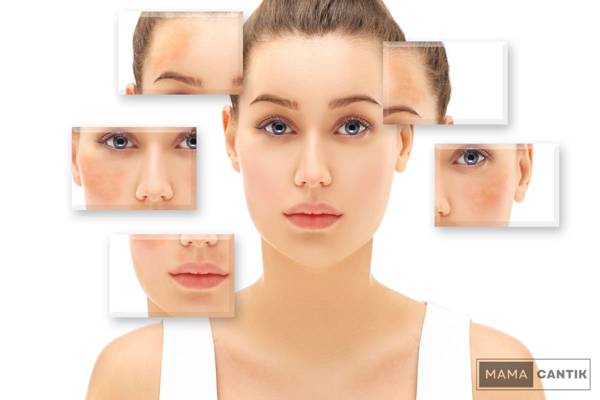 Apa itu Dark Spot? Penyebab, Jenis, dan Cara Penanganan