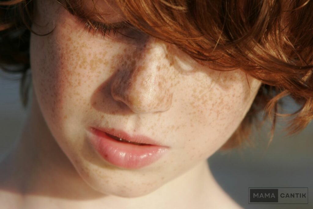 Jenis dan ciri-ciri freckles