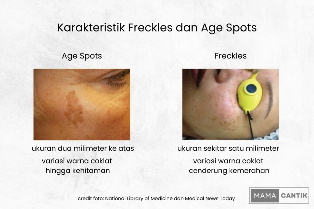 Karakteristik age spots vs freckles