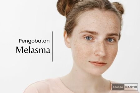 Pengobatan melasma