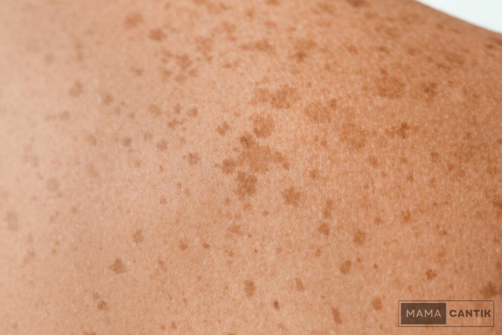 Penyebab freckles