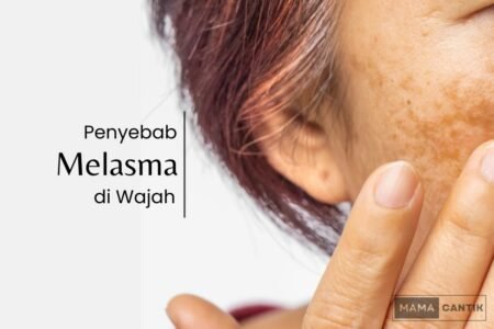 Penyebab melasma