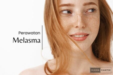 Perawatan melasma