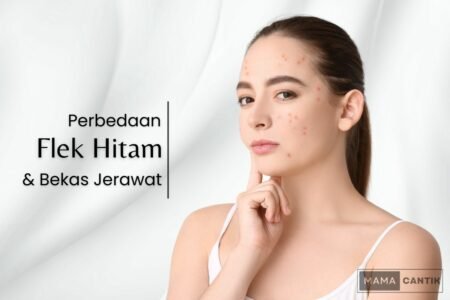 Perbedaan flek hitam dan bekas jerawat