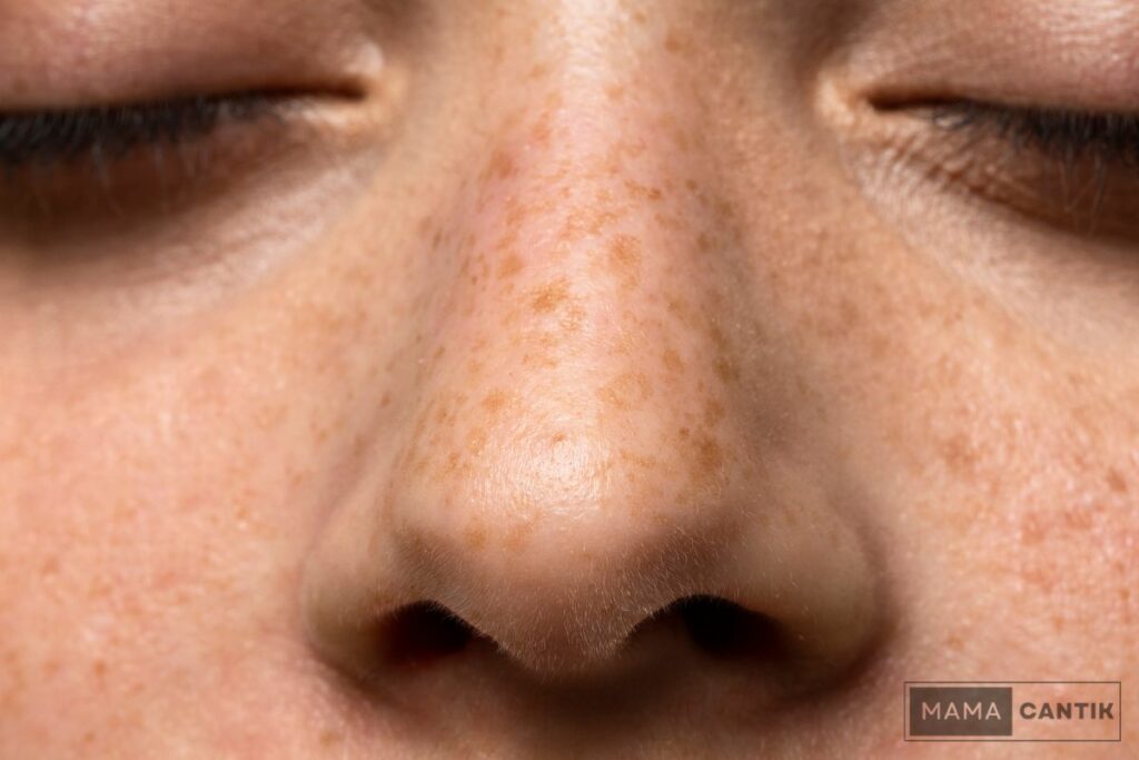 Freckles di wajah dan hidung