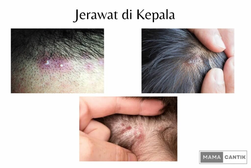 Benjolan jerawat di kepala