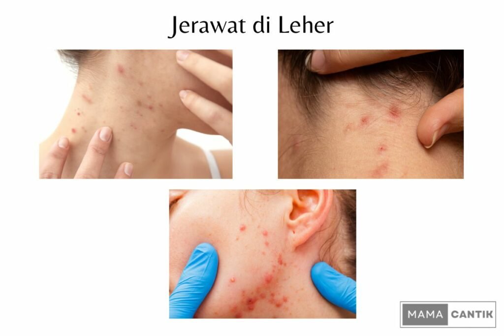 Benjolan seperti jerawat di leher