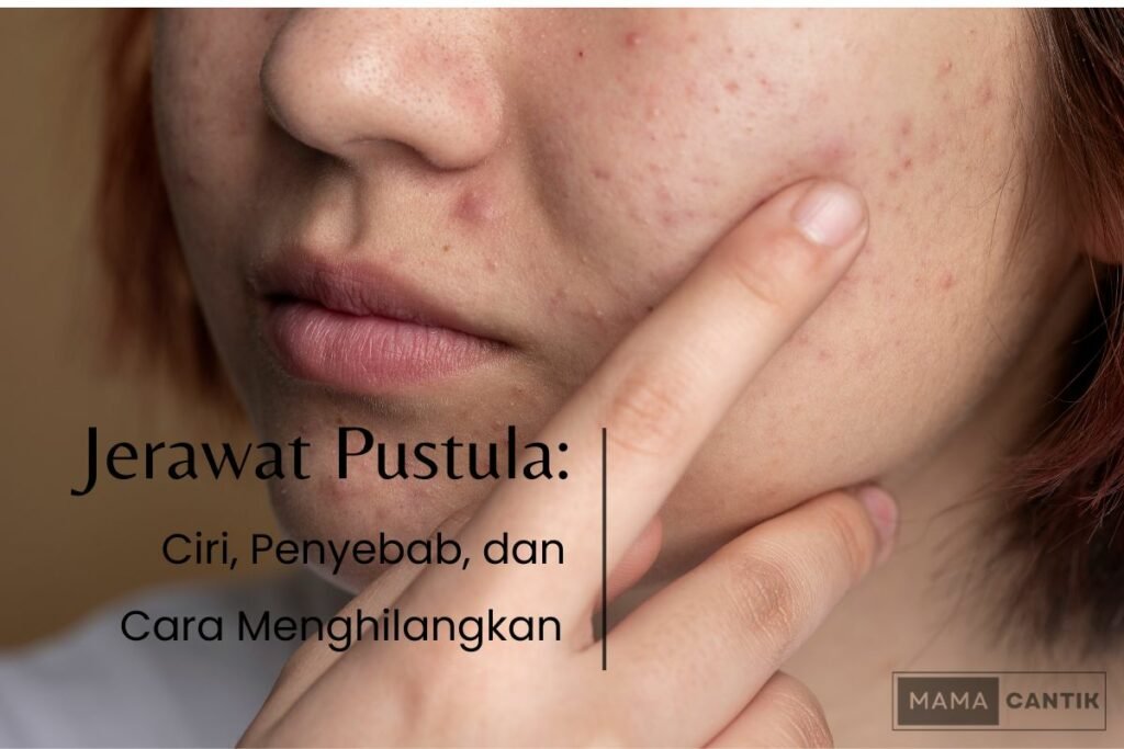 Jerawat pustula